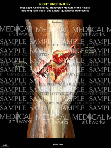 Displaced, Comminuted, Transverse Fracture of the Patella — Medical Art