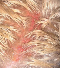 Chemical burns on the scalp from bleaching