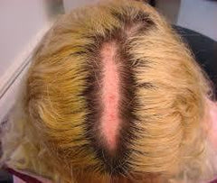 severe scalp burn
