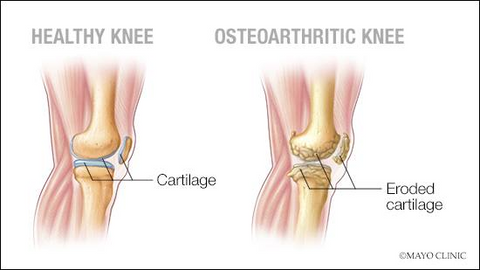 What is Osteoarthritis of the Knee