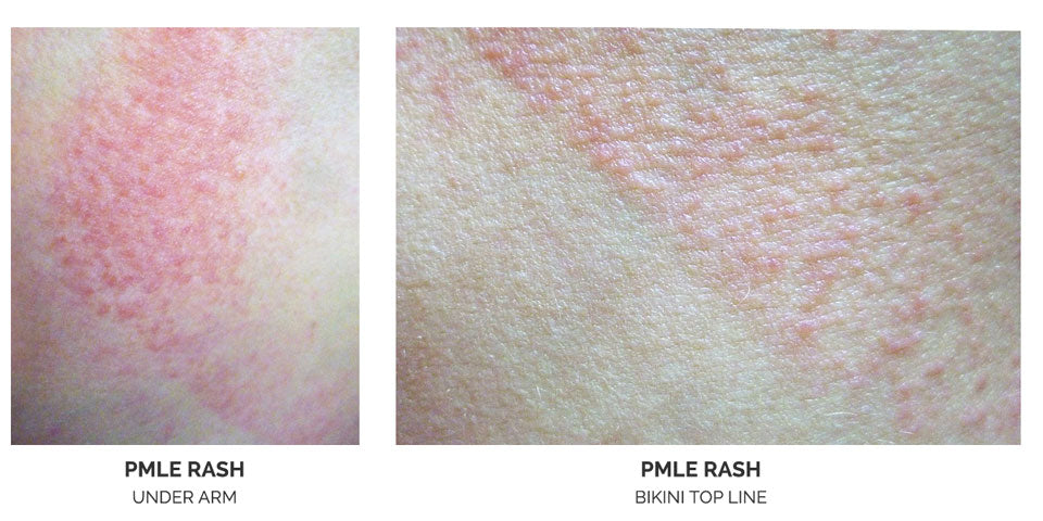 PMLE sun rash pictures