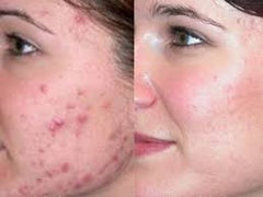 dead sea mud mask acne treatment before and after