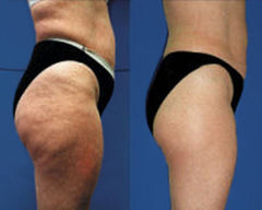 dead sea mud mask cellulite before and after
