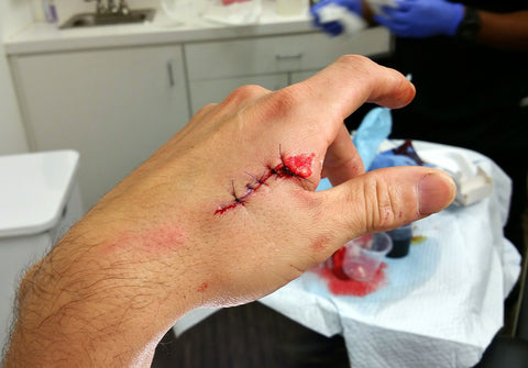 laceration after stitches