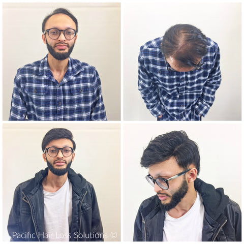 Hairpiece for young male hair loss before after Pacific Hair Vancouver