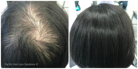 Hereditary hair loss hairpiece for woman Pacific Hair Vancouver