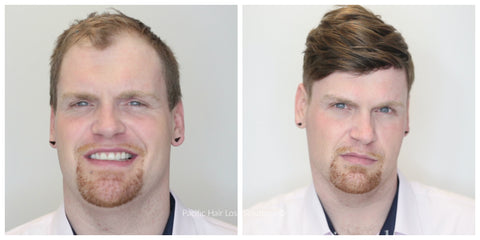 before and after male pattern baldness red hair thin skin