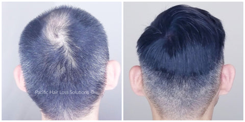 Before and after of men's hair piece with face pacific hair vancouver