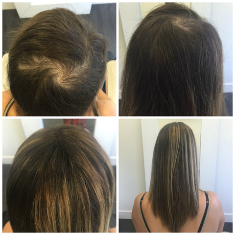 human hair piece for trichotillomania hair loss vancouver