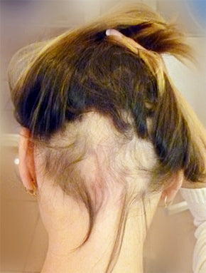 alopecia ophiasis hair loss Pacific Hair Vancouver
