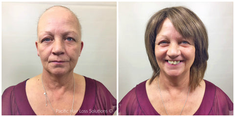 wigs for chemotherapy hair loss Vancouver