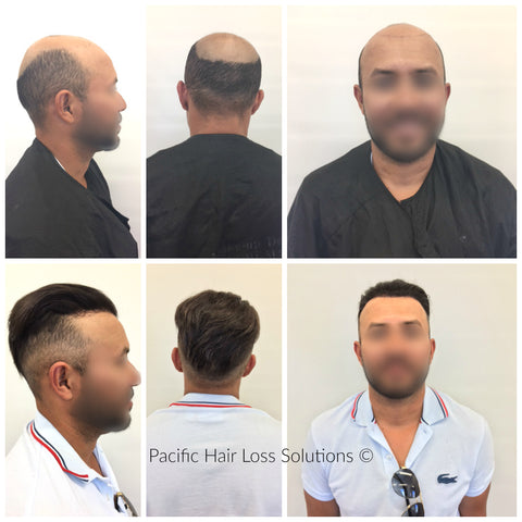 male hair piece system for fully bald head Vancouver