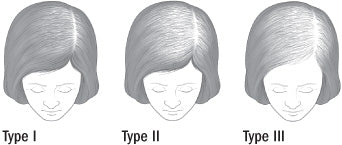 common female hair loss patterns