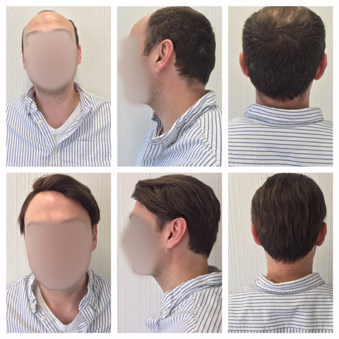 hair piece system for men's balding Pacific Hair