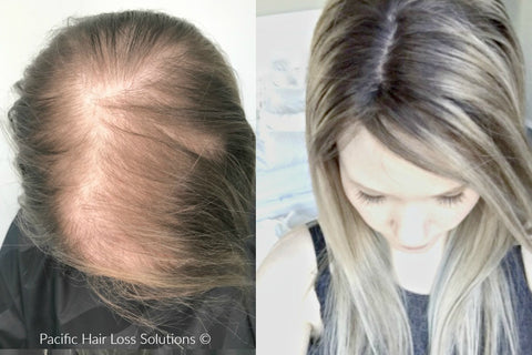 before and after blonde hair piece topper for androgenic alopecia