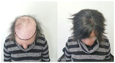 partial human hair piece for alopecia hair loss