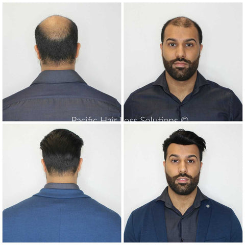 before after hairpiece for east indian man Pacific Hair Vancouver