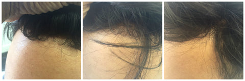 undetectable hair piece hair line vancouver