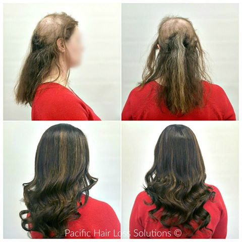 human hair wig for trichotillomania hair loss Vancouver