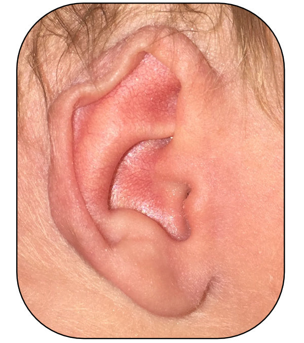 baby's ear kinked