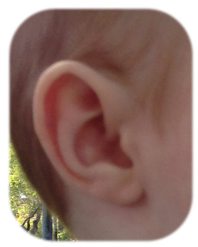 Ear Buddies has removed the rim kink deformity, leaving a normal ear