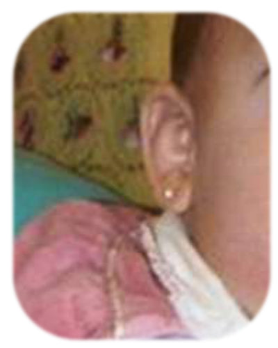 using ear correctors to fix baby stick out ears without bonnet or hat