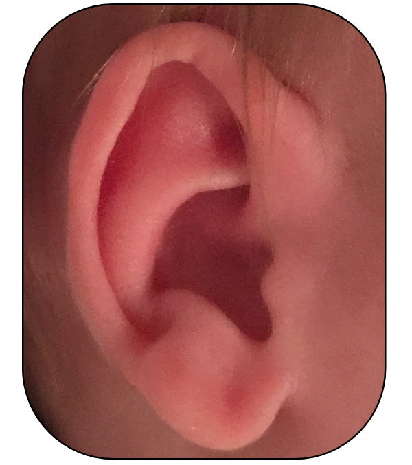 correction of kinked ears with ear buddies | parent review