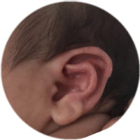 Stahl's Ear after ear buddies applied | before and after photos & reviews of EarBuddies