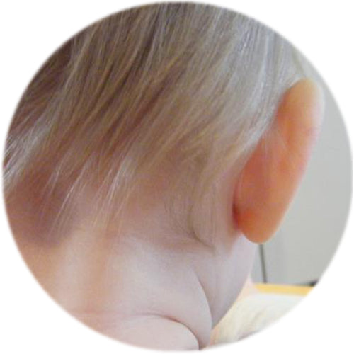 10 months after using ear buddies shapers to mold ear cartilage | stick out ears fixed