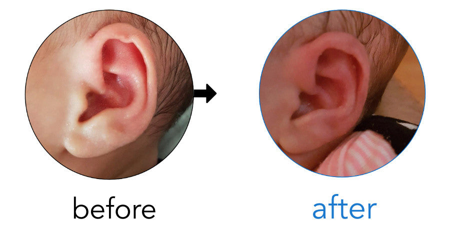 Helical Rim Deformity in babies | correct with ear buddie