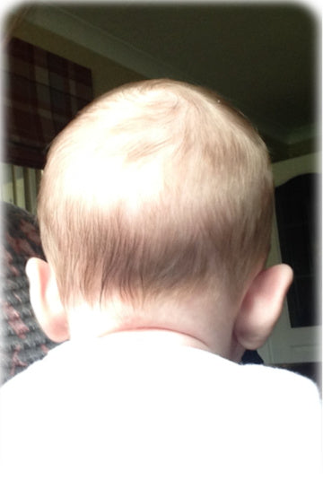 Baby with Stick Out Ears seen from the back of the head | before ear buddy