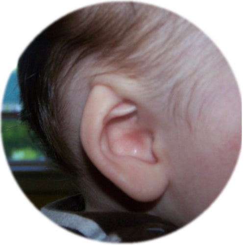 ear buddies fixes cryptotia in babies