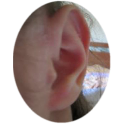 child's ear with a reformed scaphal hollow after using ear buddies to correct sticky out ears