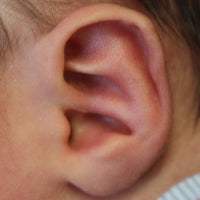 A conchal crus is a rare deformity in which a bar of cartilage crosses the conchal bowl from just above the tragus to the antihelix.