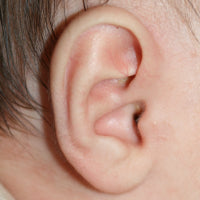 picture of a baby's ear with conchal crus or telephone ear