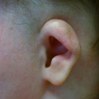 In a cup ear, the rim (helical rim or helix) is thick and constricted