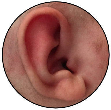 correction of stahl's bar ears with ear buddies | parent review
