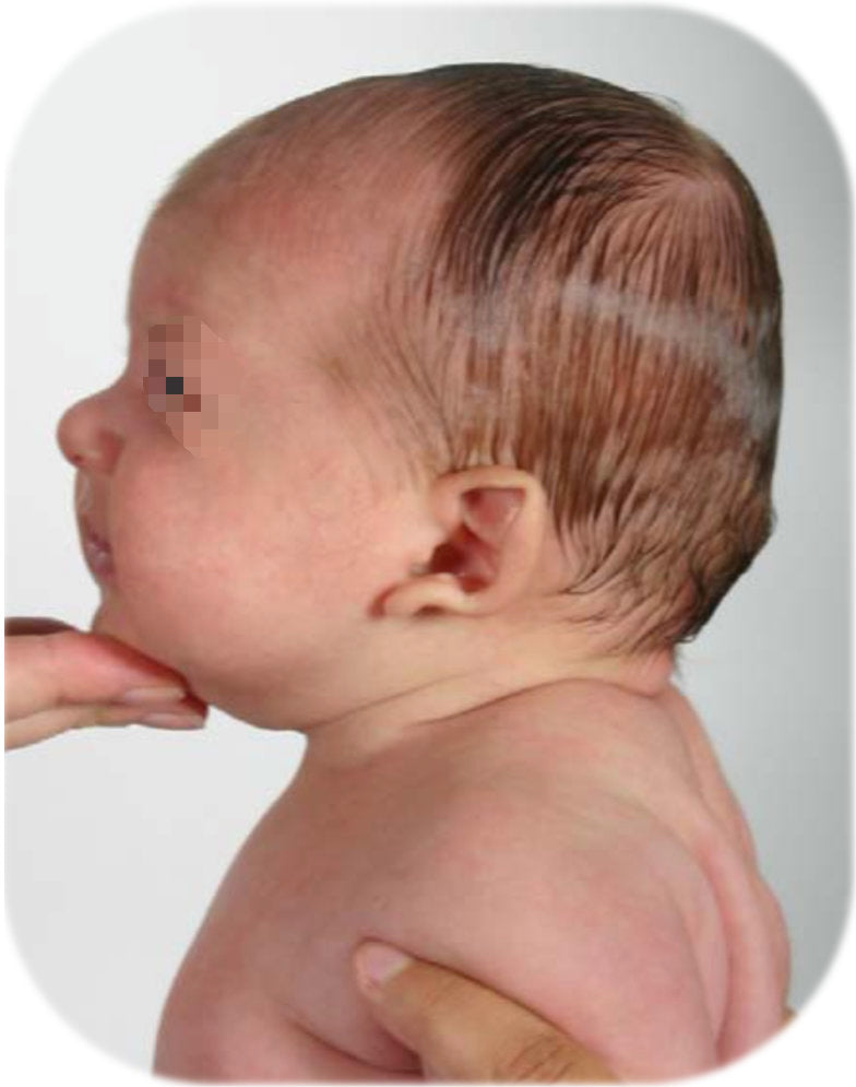 baby's left ear - combination ear deformity & malformation in neonate