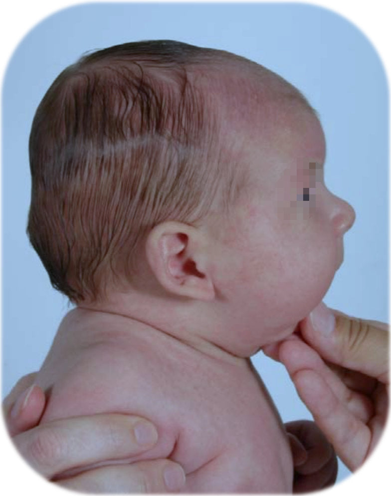 baby has multiple ear deformities like Stick-Out Ear + Stick Out Lobe + Folded Over Helical Rim