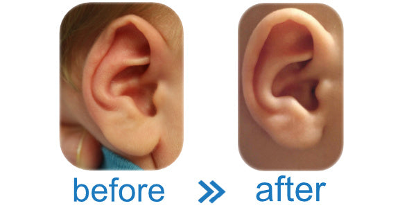Fold Over Rim | Ear Cartilage Moulded and Hardened in the correct shape