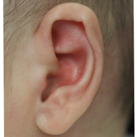 infant ear deformities | bent over edge or rim of the ear