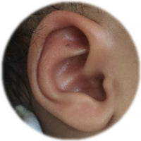 folded over helical rim deformity after using ear buddies | fixed and corrected malformation