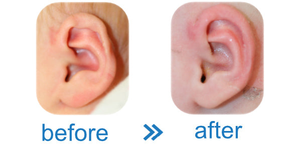 Helical Rim Deformity in babies | correct with ear buddie