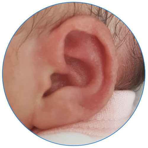 baby's ear corrected with ear molders and shapers