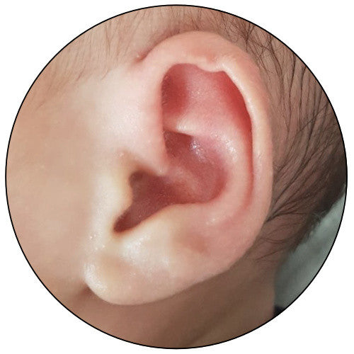 baby's ear kinked