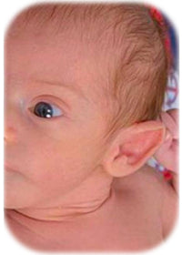 using ear buddies to treat deformities of the outer ear of baby