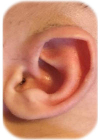earbuddy corrects newborn baby stahl's or pointed or elf ear