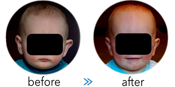baby ear folds forward | before and after results