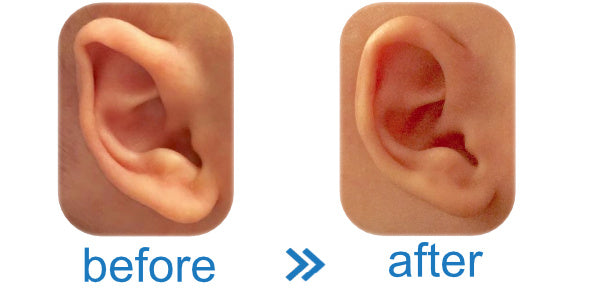 Fold Over Baby Ear fixed with Ear Buddies | Evidence that they work & Reviews