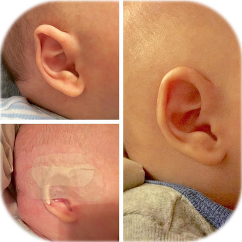 Folded Over Helical Rim deformity Corrected with ear splints by parent at home